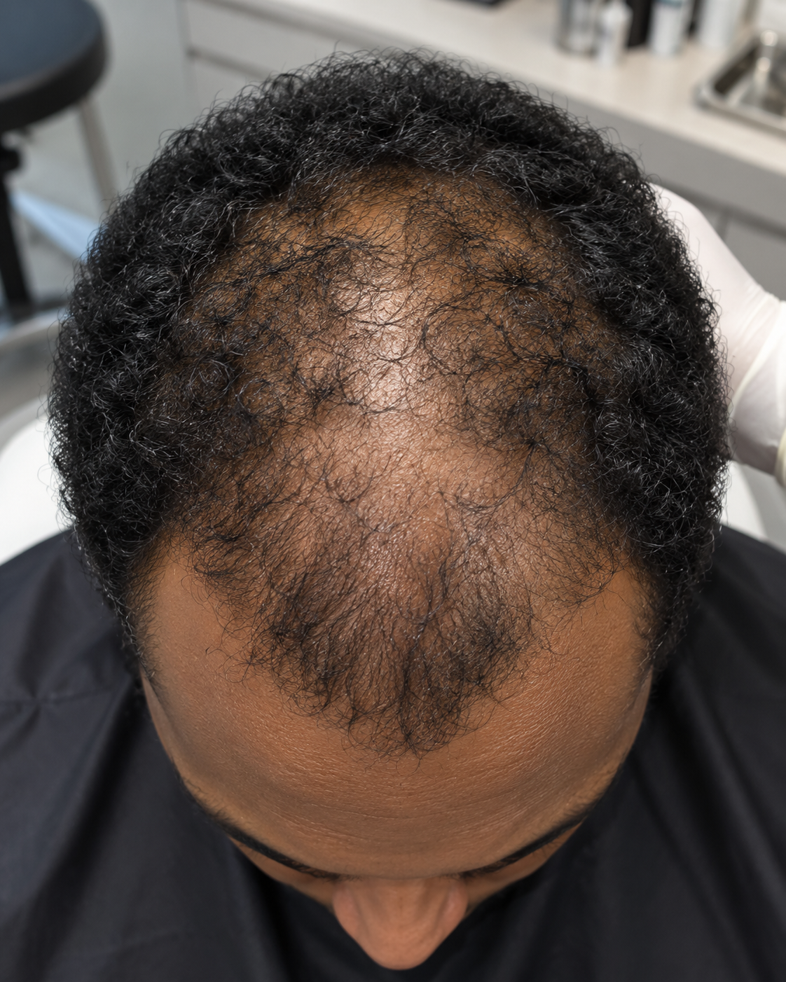 antes y despues capilar 2 zi vital