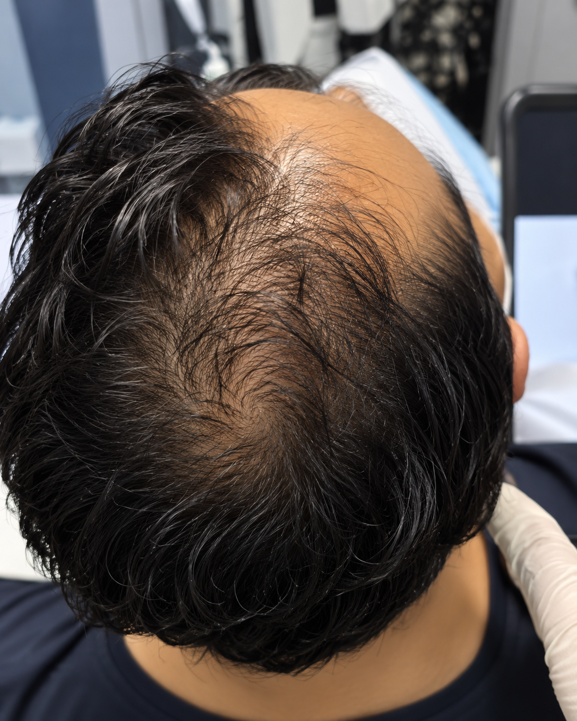 antes y despues capilar 1 zi vital